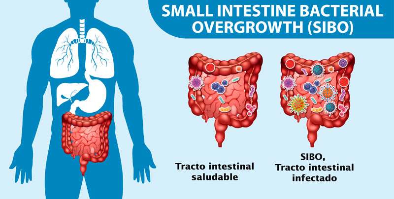 SIBO, tracto intestinal infectado